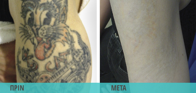 Αφαίρεση τατουάζ στο χέρι με λέιζερ. Φωτογραφία πριν & μετά το laser