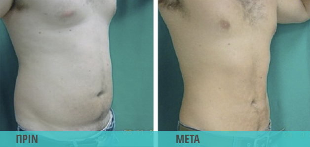 Smart Lipo : Λιποαναρρόφηση στην κοιλιά άντρα. Φωτογραφία πριν & μετά
